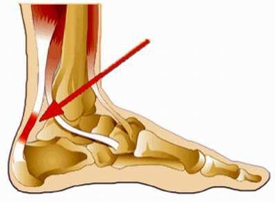 Tô Khởi chỉ cảm thấy đầu mình ong ong Rách gân gót chân là sao Bây giờ Thuỷ Tạp ở đâu rồi mẹ